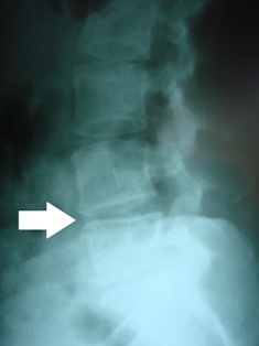 lumbar spine subluxation